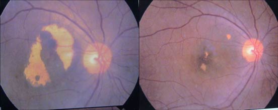 The left slide shows the eye of a 71-year old female with ARMD who after 6-months of 3mg Melatonin Zn Se daily had her vision improve from 0.2 to 0.4 (as indicated in the right slide).