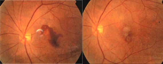 A 58 year old male whose visual acuity at the start (left slide) was 0.2. This improved to 0.4 after 6-months of regular use of Melatonin Zn Se. The sub-retinal hemorrhage and exudate was remarkably absorbed.
