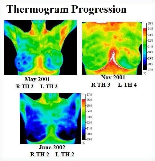 Thermogram progression from May 2001 to June 2002