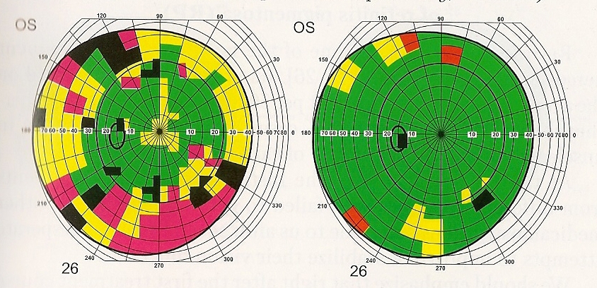 Figure Five: A field of vision test, left upon entry to the program with a 51.3% normal vision and right after treatment with Peptide Bioregulators, now with a normal vision of 93.7%