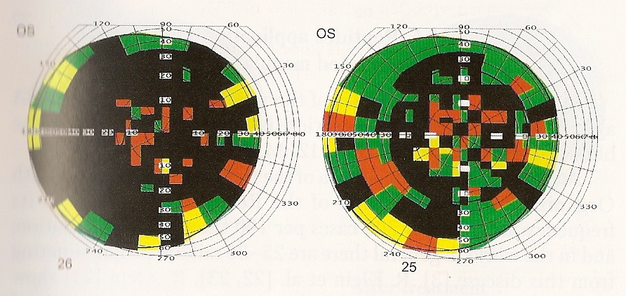 Figure Six: A field of vision test, upon admission (left) with a normal vision of 8.5% and after treatment with Peptide Bioregulators (right) with a normal vision of 29.6%