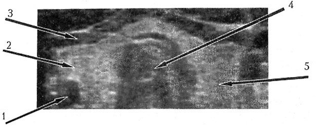 Transversal sonogram of the normal thyroid gland