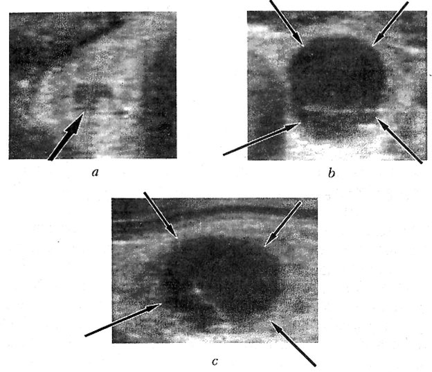 Patient P., 50 years old. Thyroid gland sonograms