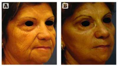 Figure 3 Patient (A) before and (B) 8 weeks after face lift 