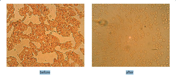 Figure 4: Red blood cells before (aggregated) and after (free-flowing) intranasal light therapy