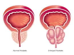 normal v enlarged prostate