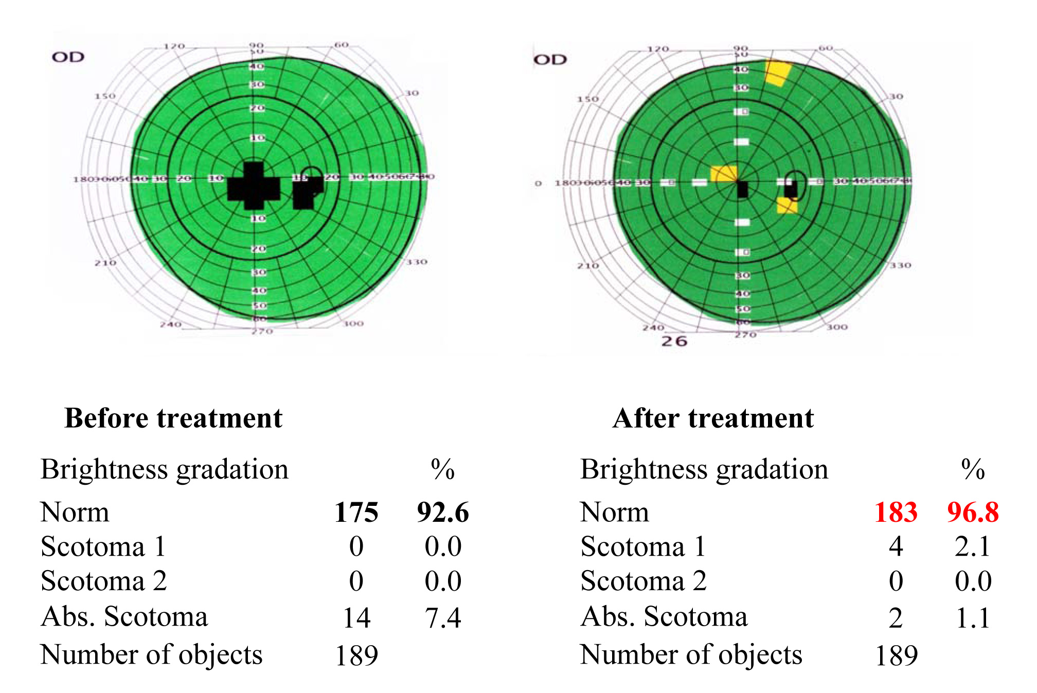 Results of the visual functions tests before and after the treatment course 4